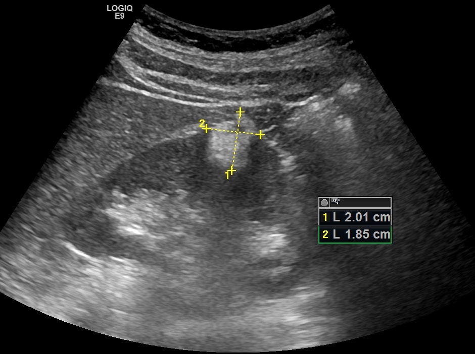 Рис. 01. Ангиомиолипома почки.