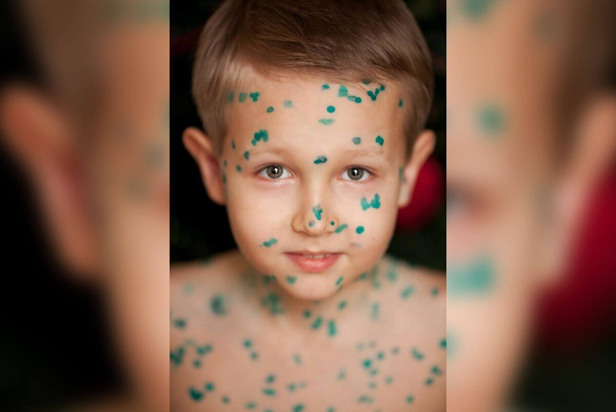    Зеленка — это антисептик, который хорошо известен только в России. Источник изображения: dzen.ru