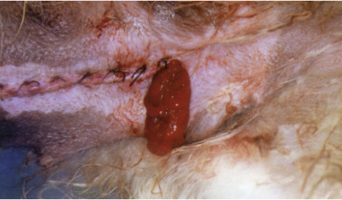 Расхождение швов и выпадение сальника. В подобных случаях риск развития перитонита очень высок