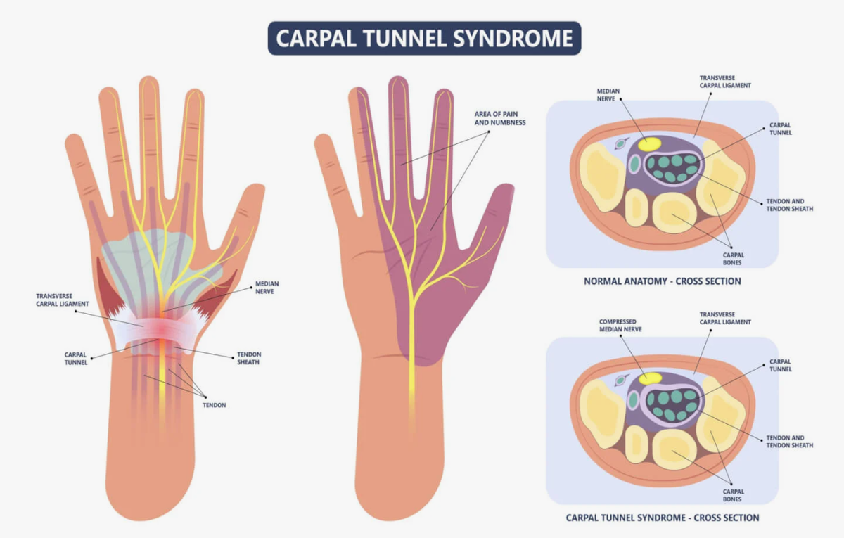компрессионная невропатия, вызванная сдавливанием срединного нерва, когда он проходит через запястный канал.