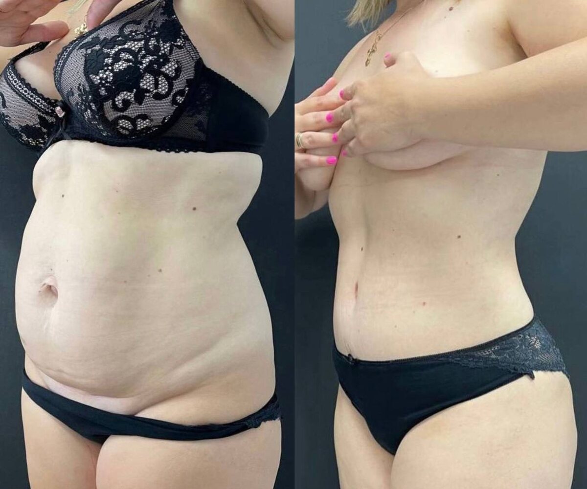 Абдоминопластика с ушиванием диастаза и пупочной грыжи, липосакция живота, пояснично-боковых зон и спины для формирования талии. Результат через 9 месяцев после операции