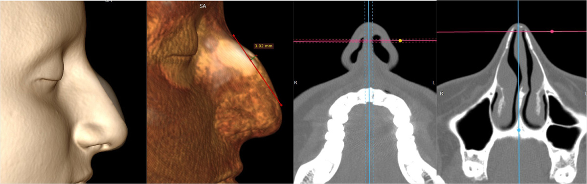Снимки КТ носа и околоносовых пазух пациентки