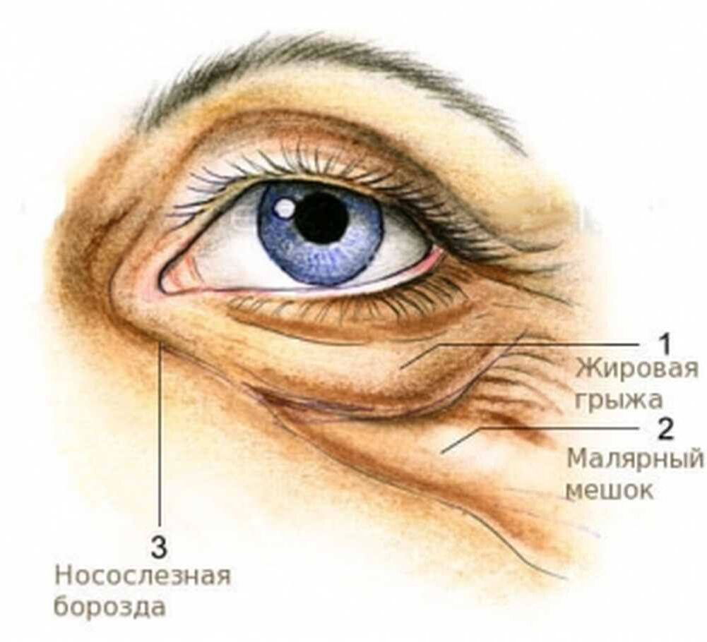 Малярные мешки или «суфы» — это видимые выпячивания под глазами в области скул: либо непосредственно на скулах или под ними, либо в области между скулами и нижним веком. Это не грыжи нижнего века, с которыми их часто путают, а именно ярко выраженные жировые комки в области скул. Часто они возникают независимо от возраста – в силу физиологических особенностей строения лица. На их появление может также влиять наследственный фактор. Так что далеко не всегда малярные мешки – результат возрастных изменений, «гуляющего»  веса  или «тяжелой жизни». Малярные мешки устраняются во время операции, при этом к стоимости операции «нижняя блефаропластика» добавляется стоимость удаления малярных мешков, поскольку это – дополнительная манипуляция.