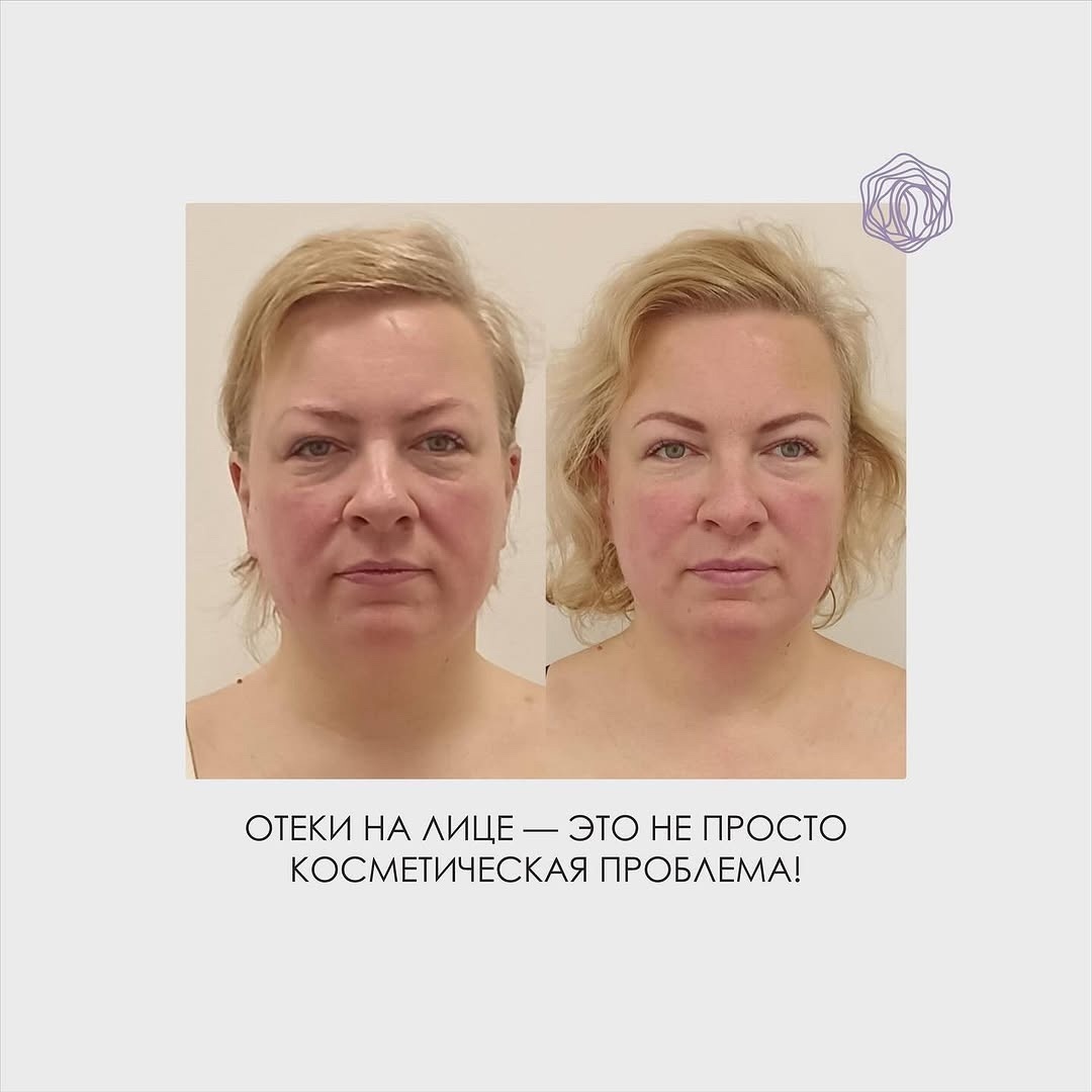 Клиника "Остео лайт"

Лишняя жидкость в тканях вызывает ощущение тяжести, деформирует овал лица и ускоряет старение кожи. Причины могут быть разными.

Но решение есть! 

Фейспластика помогает устранить отёки, подтянуть кожу и вернуть лицу свежесть. Результат — чёткий контур, открытый взгляд и здоровый цвет лица.

Хотите такой же эффект? Напишите «ХОЧУ» в комментариях или в личные сообщения, и мы расскажем, как помочь вашему лицу выглядеть моложе и свежее!