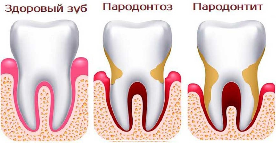Пародонтит и пародонтоз, причины разные результат один