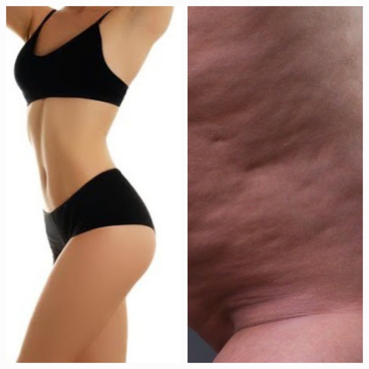 Стадии развития целлюлита. 