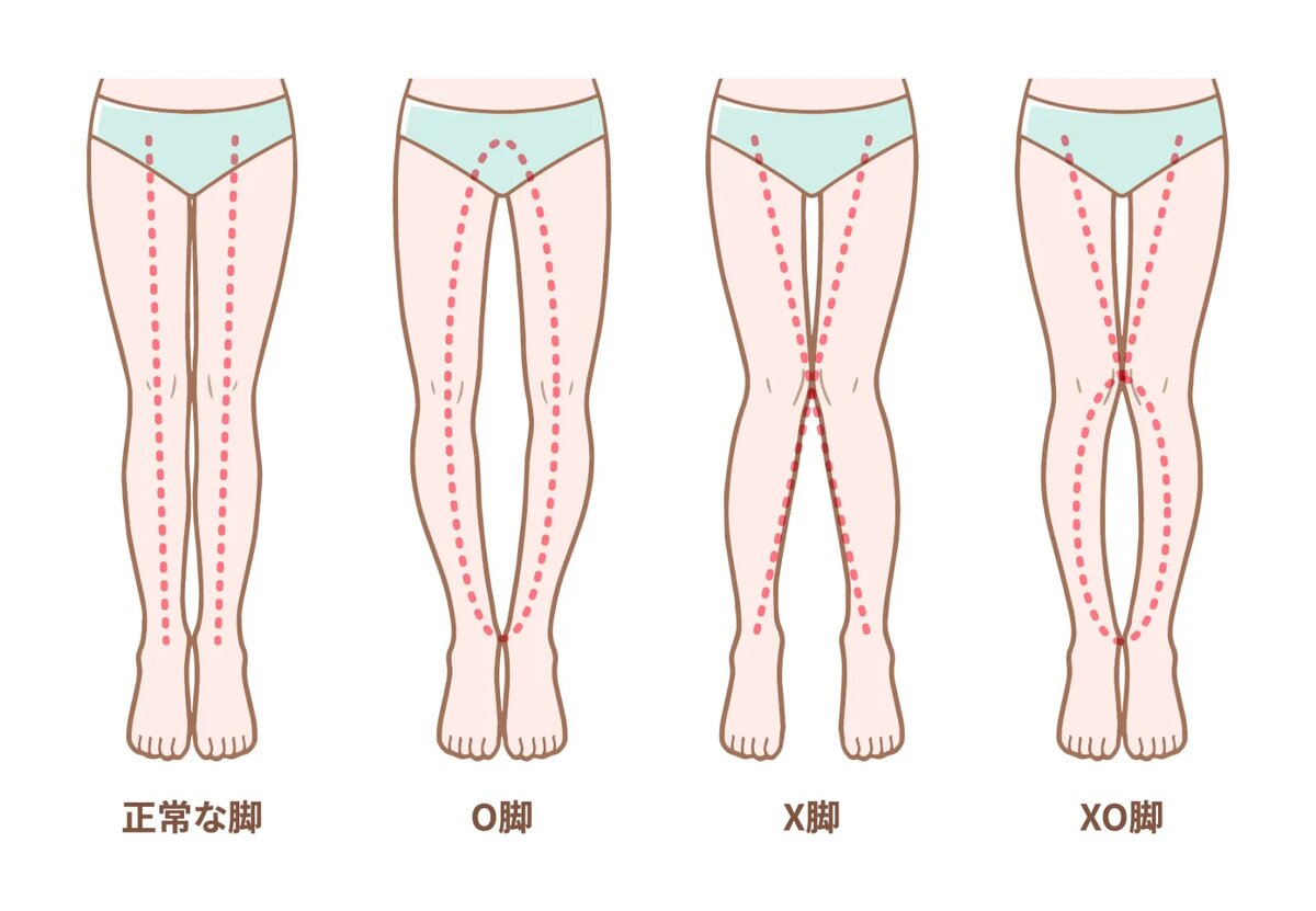 Виды искривления ног. Слева направо: ноги без искривления, О-образное, Х-образное и ХО-образное искривления.