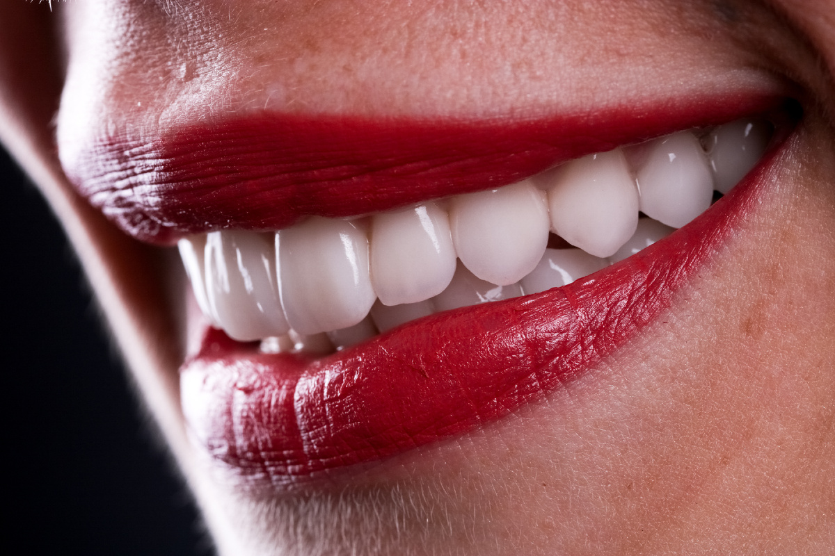 Керамические виниры выглядят как собственные зубы!