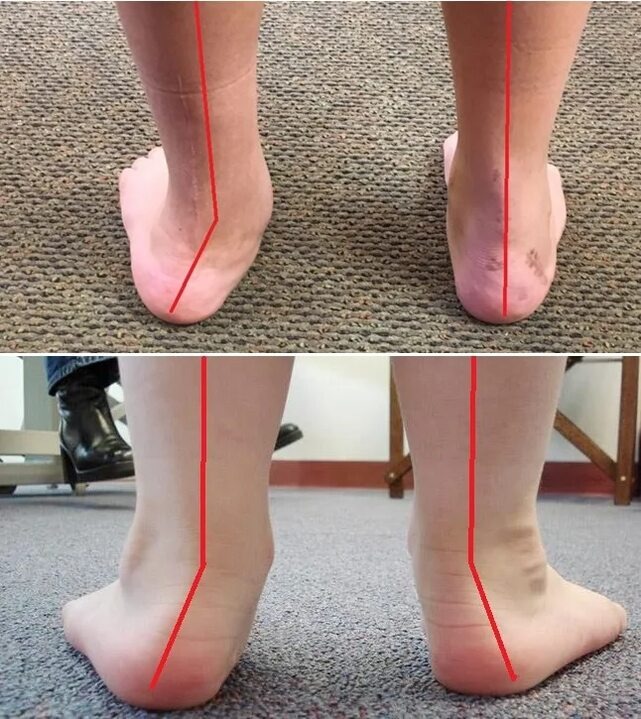 Так выглядит вальгусная стопа. Фото из открытых источников