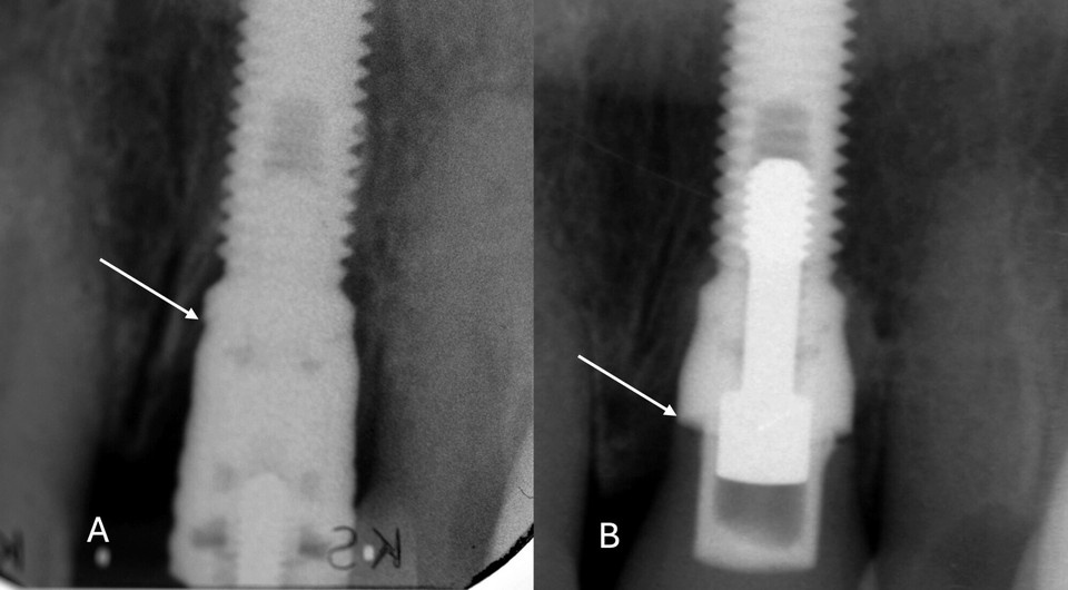   Sargon Barkarmo, Jan Kowar / Clinical Implant Dentistry and Related Research, 2025