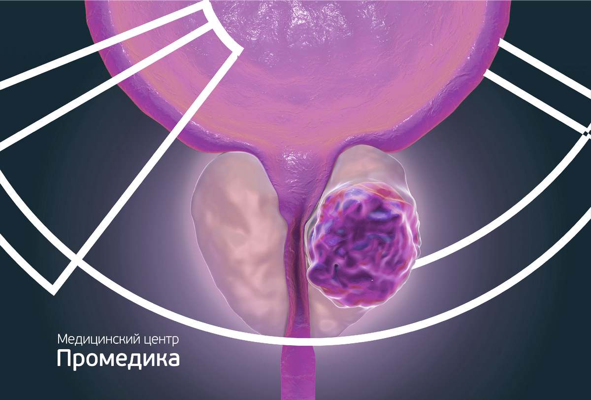 Консервативное лечение простатита: медикаментозная терапия и физиотерапия