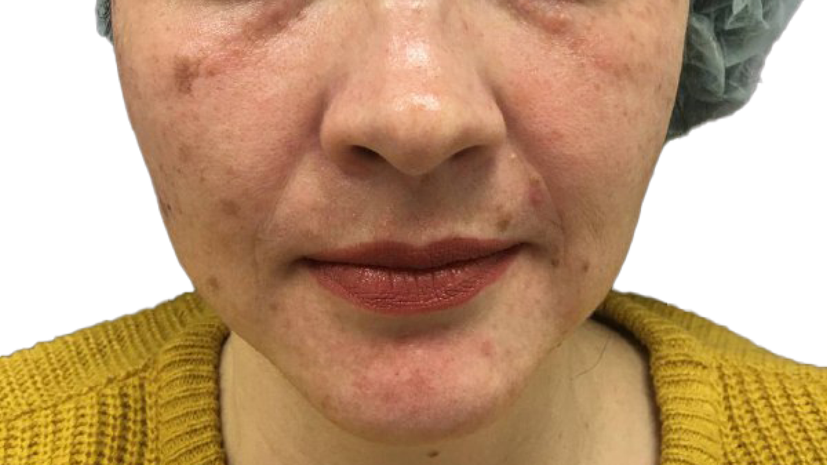 До процедуры AFT фотоомоложения в клинике GEN87