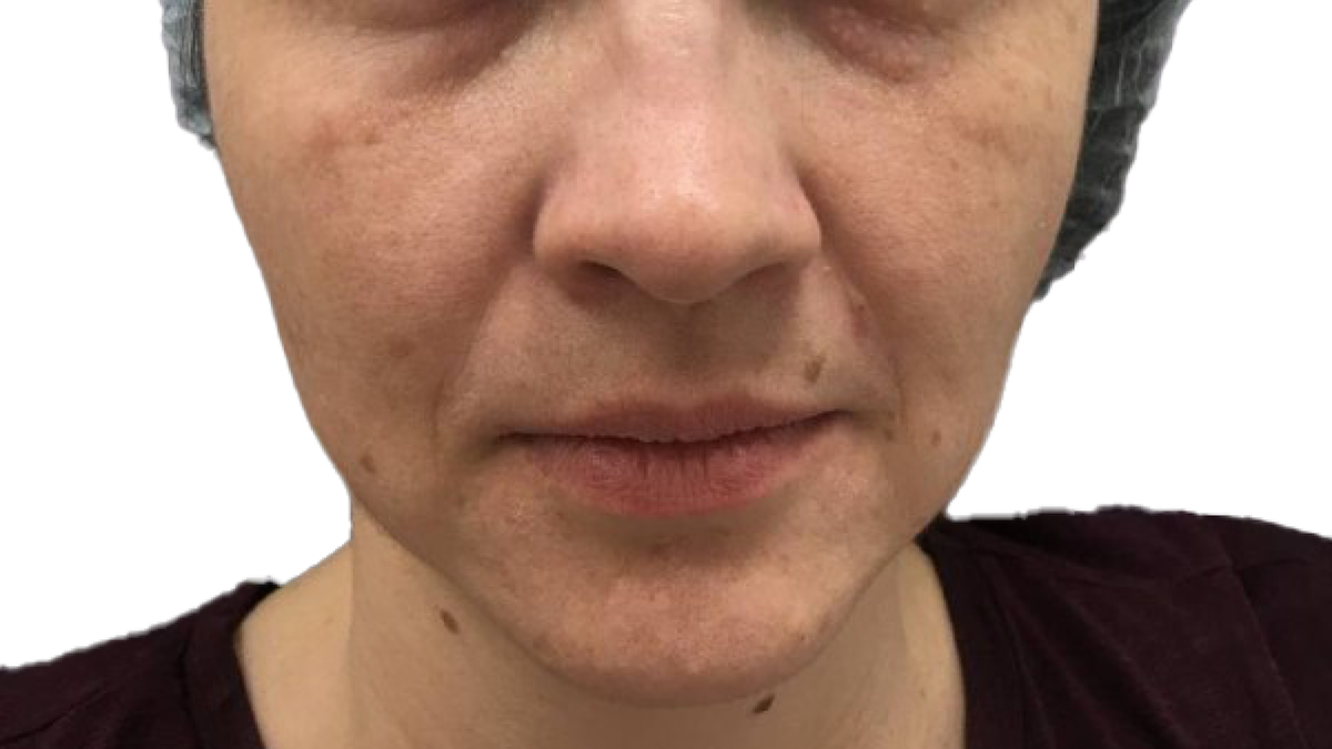 Фото после процедуры AFT фотоомоложения в клинике косметологии GEN87