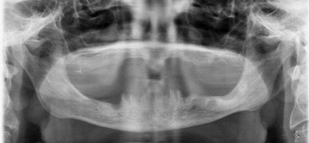 Полная адентия на снимке