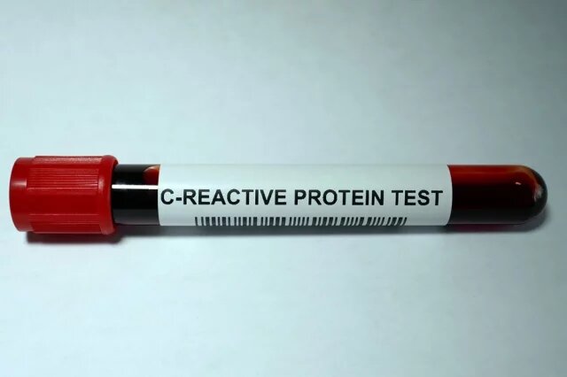    Что делать, если повышен C-реактивный белок?