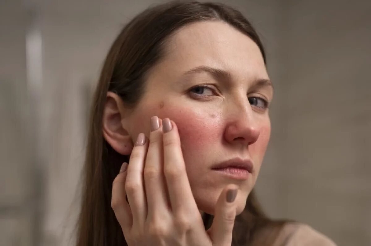    В Перми врач прокомментировал сообщение о вспышке холодовой аллергии