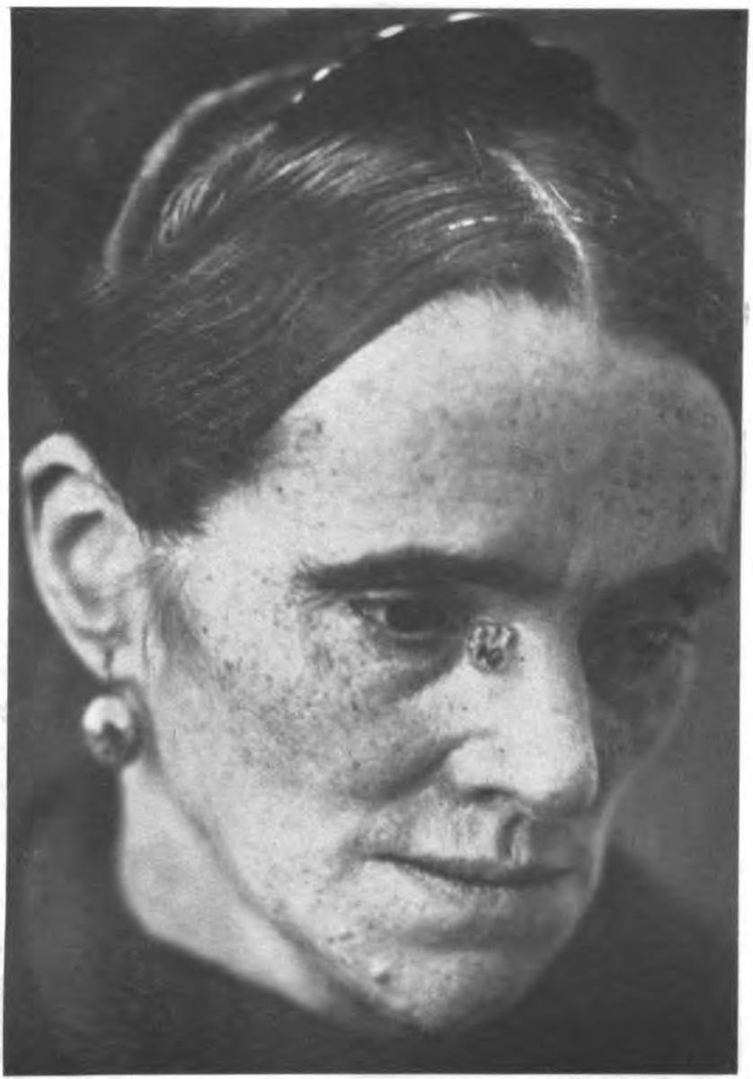 Пиломатриксома кожи лица (на границе внутреннего угла правого глаза и верхней трети спинки носа справа). Фото из открытых источников. 