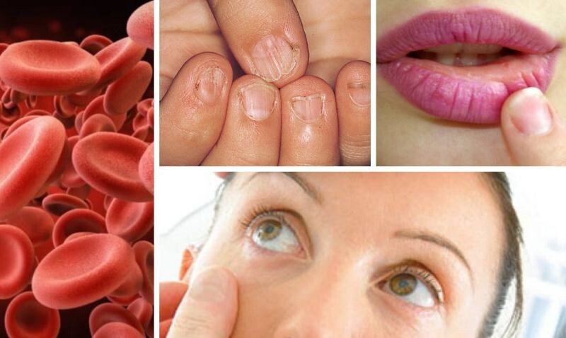 Доподлинно известно, что организму для здорового функционирования ежедневно требуются не только витамины, но и микроэлементы. Железо - один из них. Железо является составляющим гемоглобина, участвует в десятках различных биохимических процессах, и не только. При хроническом дефиците этого микроэлемента нарушится работа всех систем органов и разовьётся анемия. Крайне важно поддерживать содержание железа в крови на должном уровне и вовремя выявить дефицит.

Для чего нужно железо организму?
2-5 г железа - таково количество микроэлемента содержится во всем теле взрослого человека, причем большая часть, около 70%, сосредоточены в кровяных клетках. В печени, селезенке, мышцах и костях распределены остальные 30%. Важность железа для здорового функционирования человеческого организма невозможно переоценить.

В первую очередь железо входит в состав гемоглобина. Исследованиями доказано, что железо выступает компонентом многих ферментов, участвует в процессе деления клеток, обмене биологически активных веществ и биосинтетических процессах, энергетическом обмене. Ферменты с железом в составе принимают участие в продукции гормонов щитовидной железы, поддерживают иммунитет, в частности местный. Оно же необходимо для синтеза ряда биологических веществ, включая интерферон и тканевого дыхания. Интересен тот факт, что железо участвует в процессе формирования рецепторов дофамина – гормона, повышающего мотивацию и способности радоваться жизни.

Таким образом, железо обеспечивает функцию дыхания, поддерживает энергичность и тонус организма, снижает риск развития атеросклероза и последующих ему осложнений, поддерживает оптимальный вес тела, обеспечивает нормальную работу всех органов и тканей, головного мозга, уменьшает вероятность развития нарушений обмена веществ, поддерживает иммунитет.
