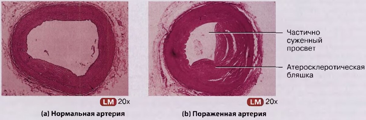 Микрофотографии поперечного сечения
а) нормальной артерии и
б) артерии, частично перекрытой атеросклеротической бляшкой.