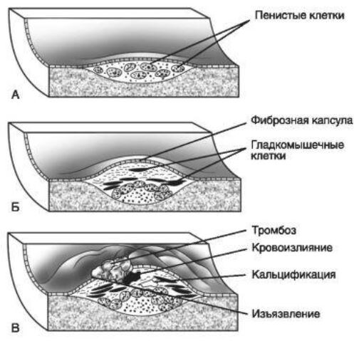 Стадии атеросклероза:
А - жировая полоска;
Б - фиброзная бляшка;
В - осложненное поражение.