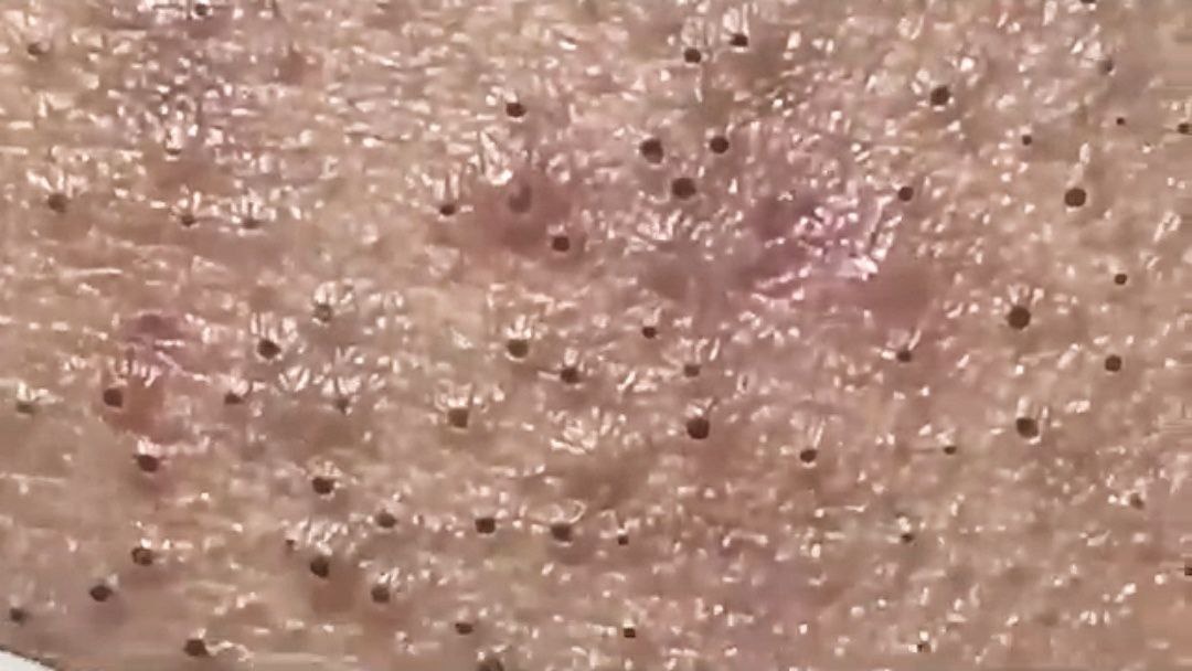 Пример акне, фото взято из открытых источников