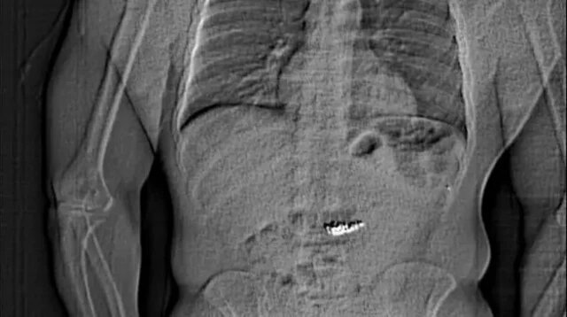 Подпись к фото,В животе у подозреваемого был обнаружен посторонний объектАвтор фото,Orlando Police