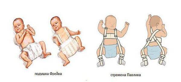 Дисплазия бедра - неприятное состояние для детей и родителей, но успешно лечится  