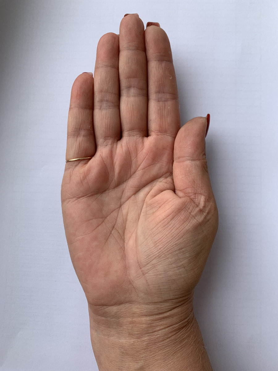 Пониженная посалка мизинца. Бывает мизинец понижен еще сильнее, это еще лайт