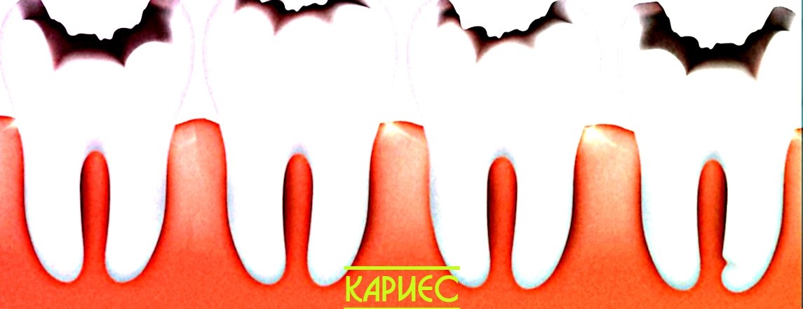 Кариес как вред здоровью