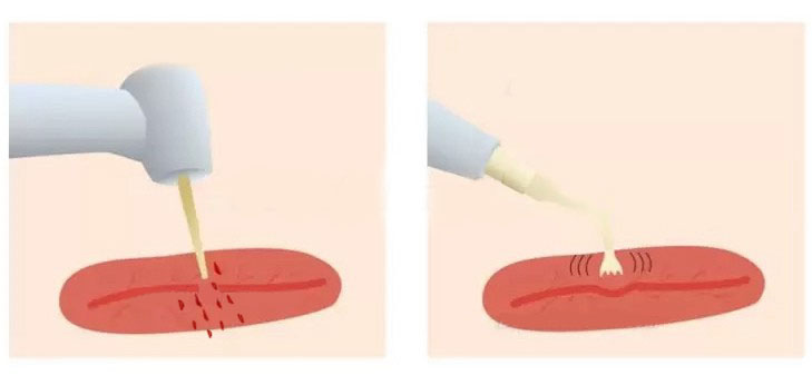 
Ультразвуковой разрез в отличие от традиционного не повреждает мягкие ткани.