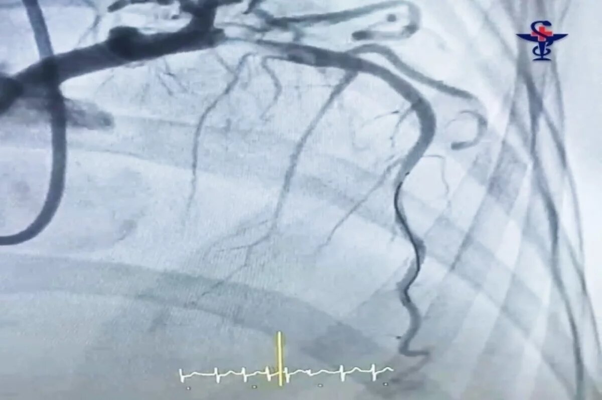    В Астрахани врачи успешно провели операцию при обширном инфаркте