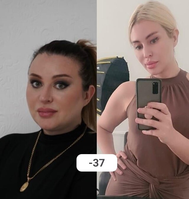 Результат после бариатрической операции