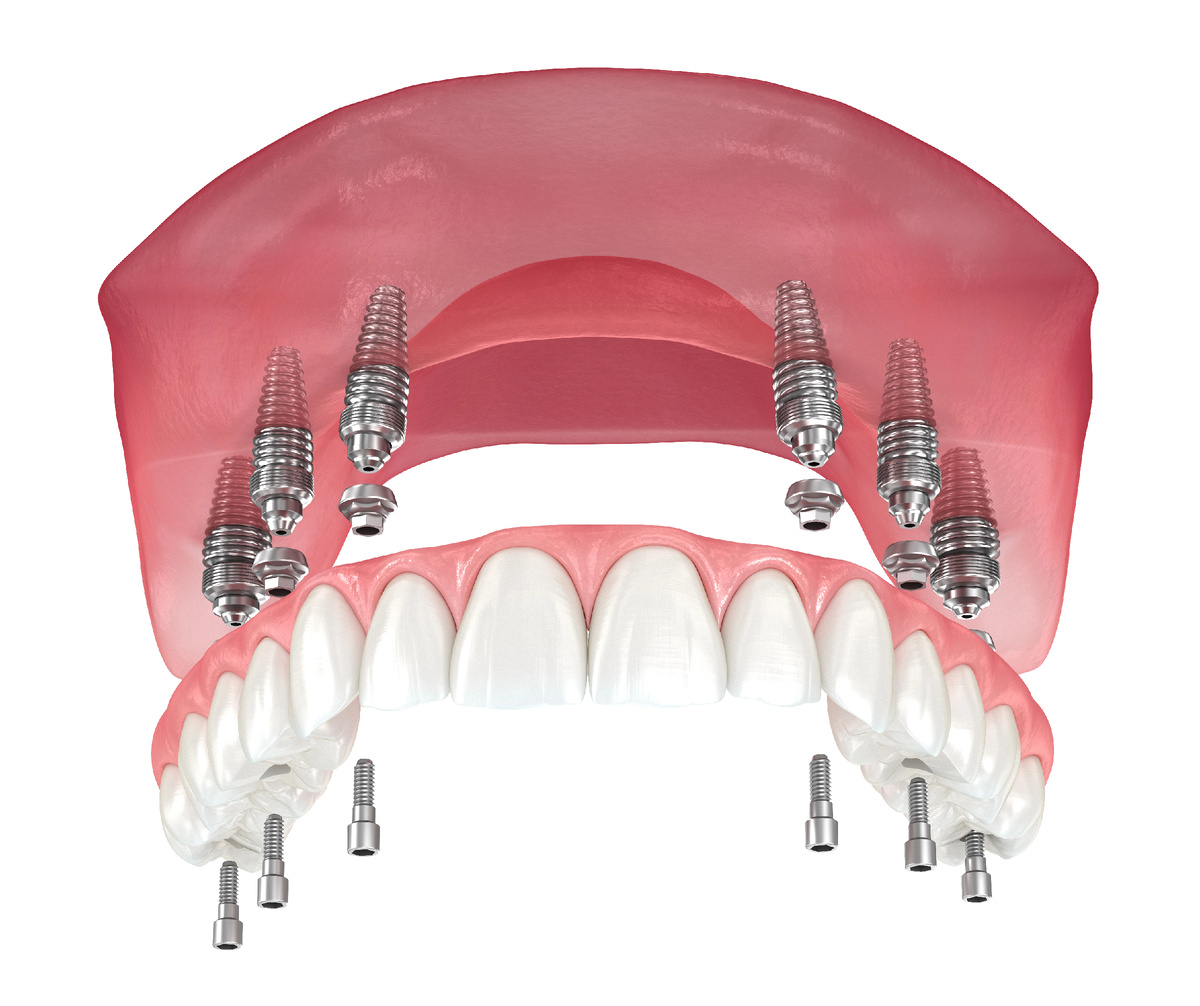 Полный несъемный протез с опорой на импланты