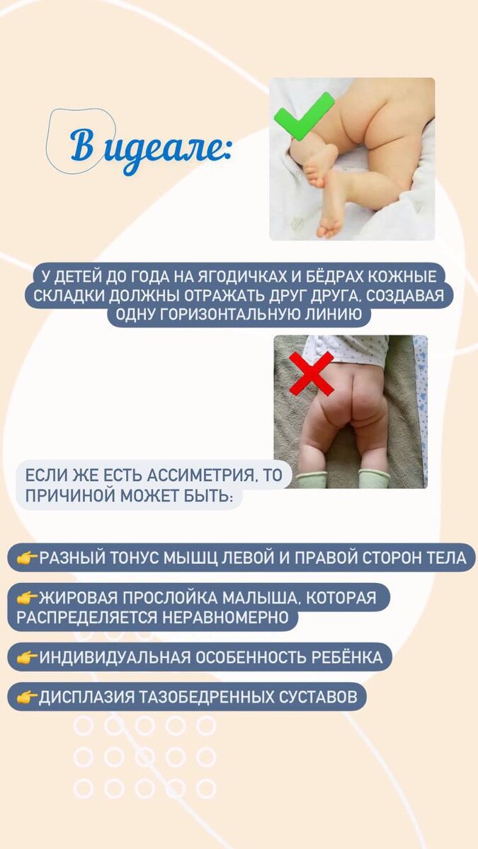 несимметричные складки у ребенка