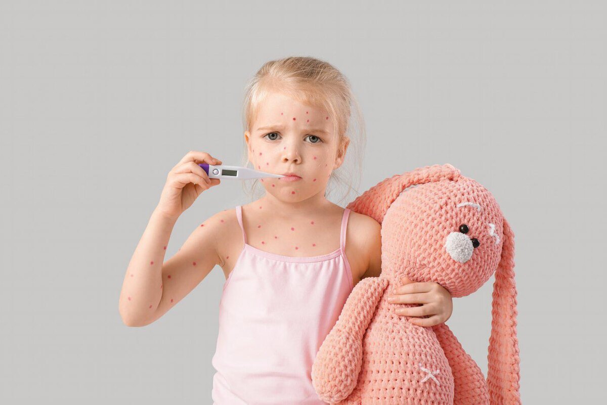 Ветрянка опасна и для детей, и для взрослых. Pixel-Shot / Copyright (c) 2024 Pixel-Shot/Shutterstock. No use without permission.