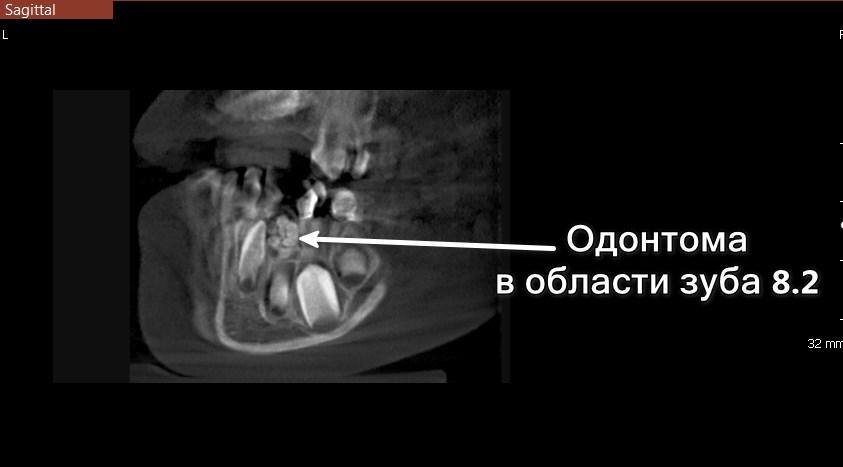 Одонтома нижней челюсти в области зуба 8.2