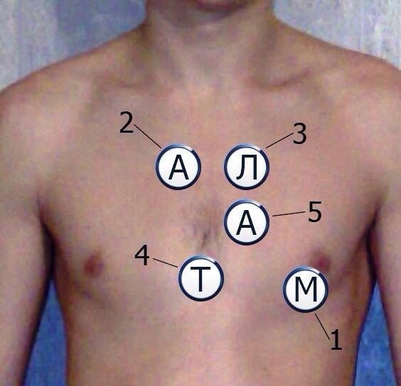 Запомни 5 точек аускультации сердца!
