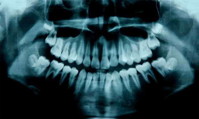 Рентген зубов у детей.