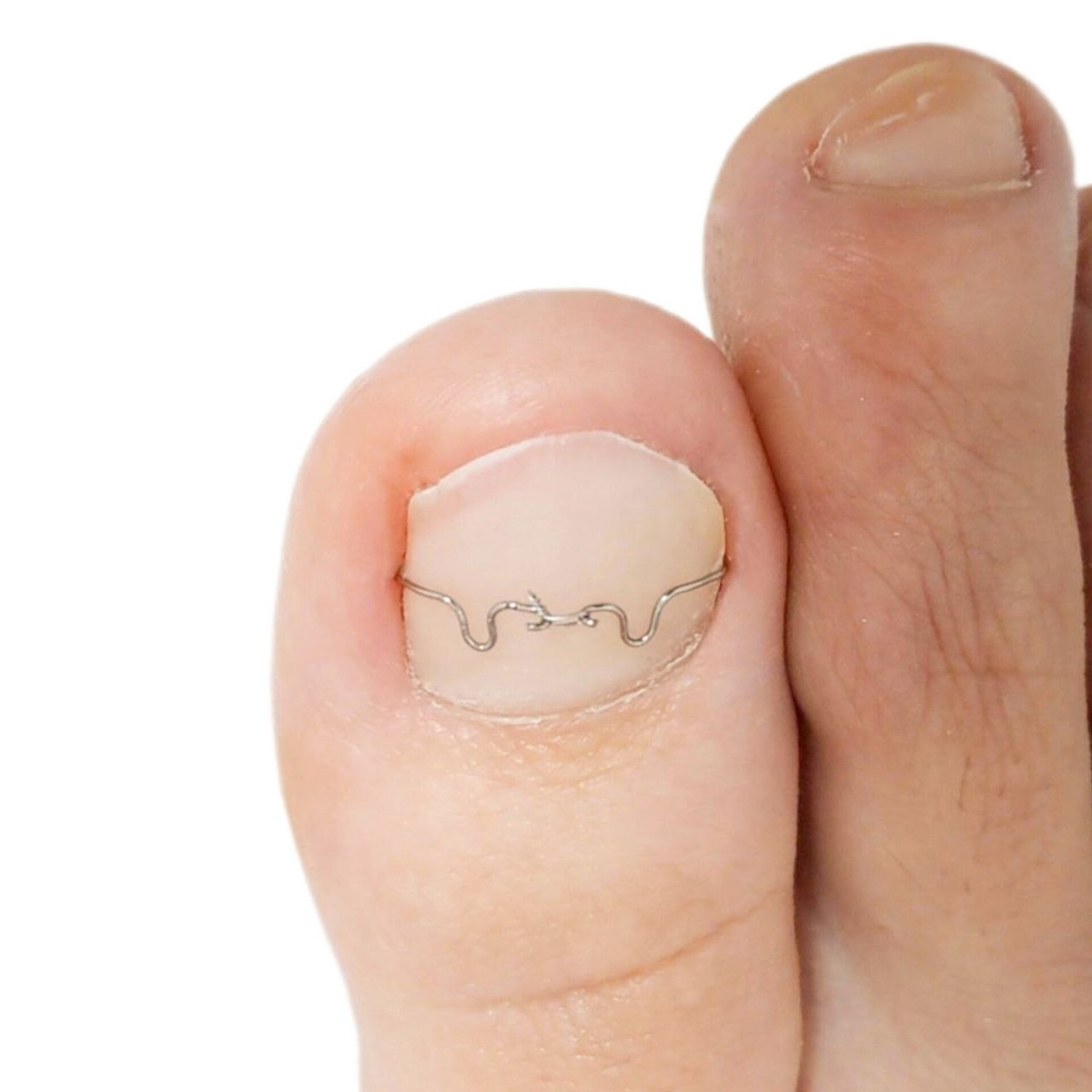 Скоба 3ТО без фиксирования композитом