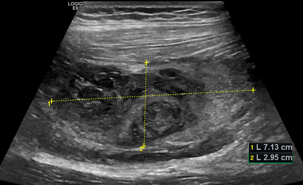Рис. 01. Межмышечная гематома, продольное сканирование