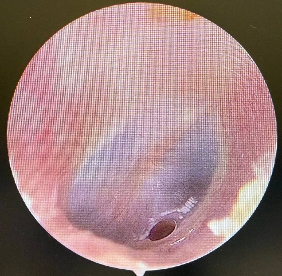 На фото перфорация барабанной перепонки. 