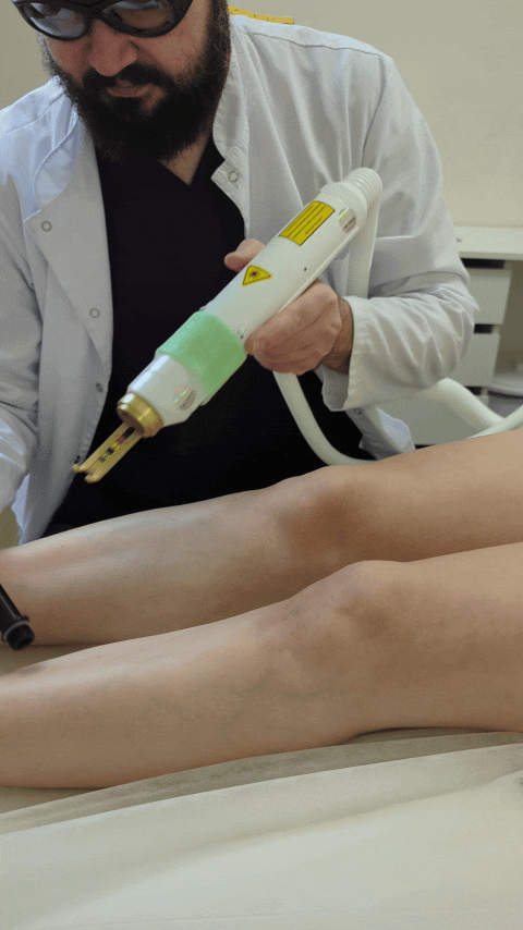 Во время CLaCS мы обдуваем кожу холодным воздухом и поочередно выполняем сначала чрескожную лазерную коагуляцию, а затем слкеротерапию. Мой любимый способ лечения сосудистых звездочек