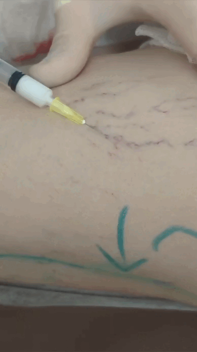 В процессе процедуры звездочки красиво исчезают, но после этого они снова появятся и будут рассасыватсья несколько месяцев. Про это мы поговорим в следующей статье