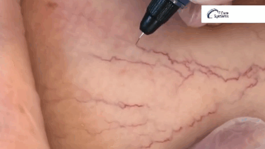 Специальная игла нагревается и точечно прижигает сосуды