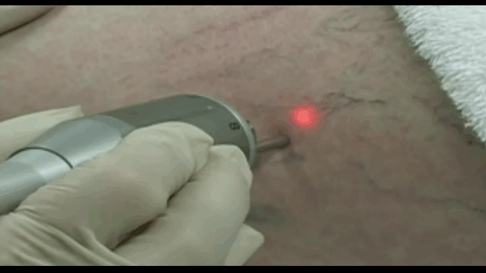 Лазерный луч запаивает сосуд