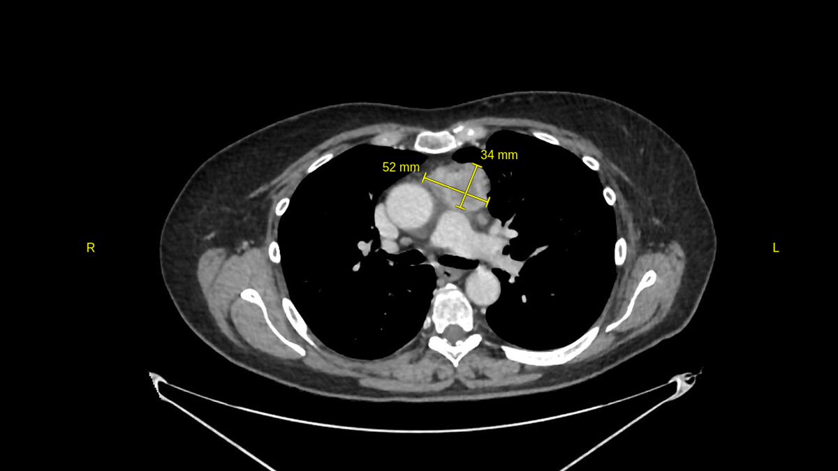 Новообразование переднего верхнего средостения на КТ