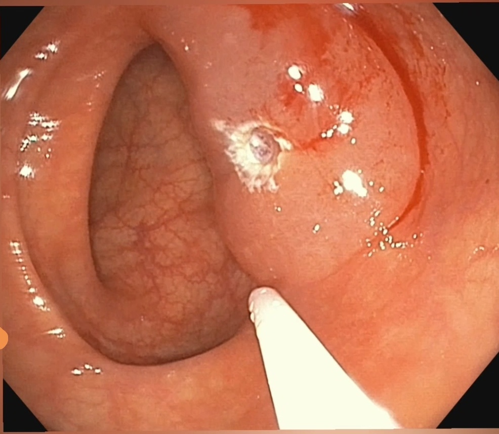 EMR - эндоскопическое электрохиругическая резекция 
