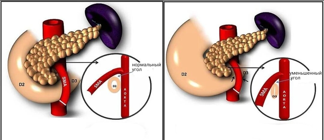 SMA - верхняя брыжеечная артерия, D2,D3 - отделы двенадцатиперстной кишки