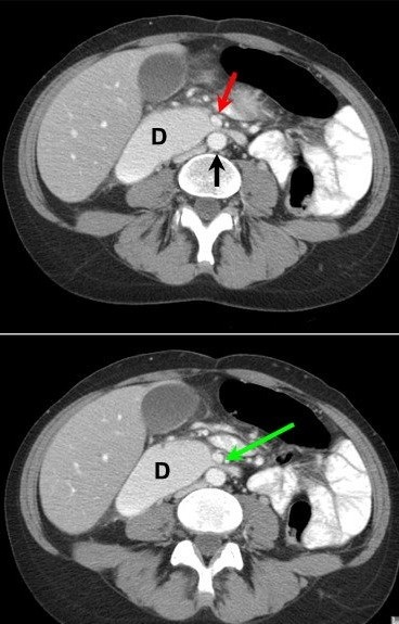 На аксиальных срезах ОБП в венозную фазу исследования отчётливо видно уменьшенное расстояние между аортой (черная стрелка на верхнем изображении) и ВБА (красная и зелёная стрелки): менее 10 мм. D-duodenum, престенотическое расширение нисходящей части и компрессия горизонтального отдела двенадцатиперстной кишки между двумя сосудами (симптом "клюва")