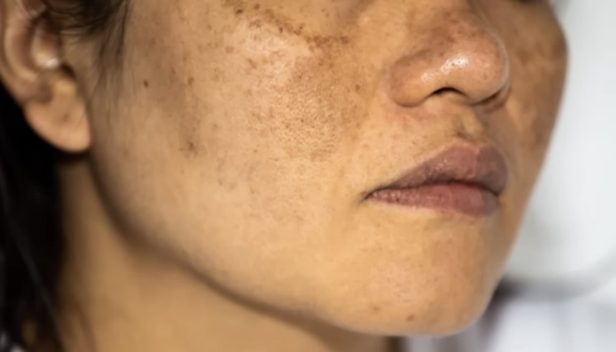 Пример мелазмы на лице (фото из Интернета)